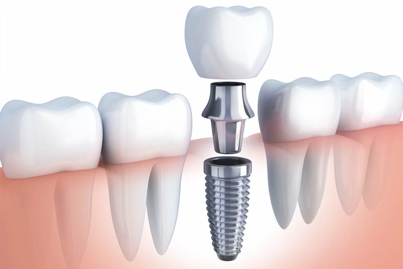 Implants Dentist in San Gabriel